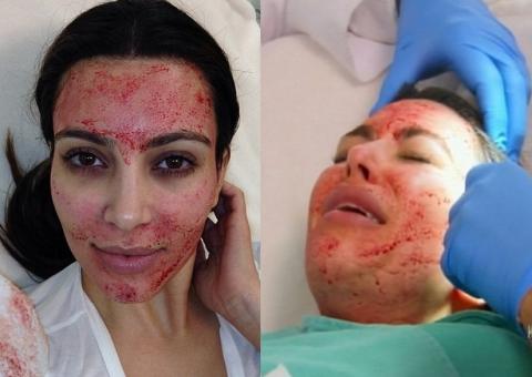 Kim Kardashian faz tratamento de beleza com sangue